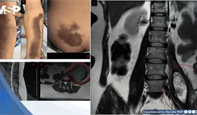 Manipulaci&oacute;n quiropr&aacute;ctica genera hematoma de iliopsoas y da&ntilde;o neurol&oacute;gico en paciente con von Willebrand