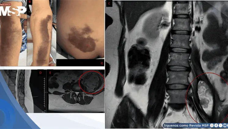 Manipulación quiropráctica genera hematoma de iliopsoas y daño neurológico en paciente con von Willebrand Manipulación quiropráctica genera hematoma de iliopsoas y daño neurológico en paciente con von Willebrand