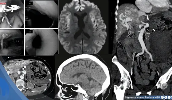 Hemorragia gastrointestinal provoc&oacute; edema cerebral en paciente con Telangiectasia y malformaci&oacute;n hep&aacute;tica