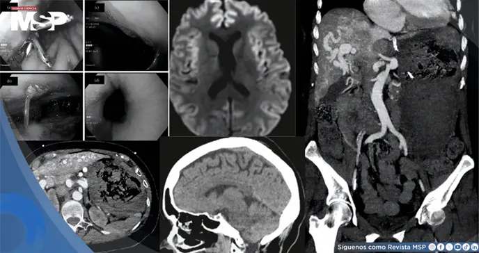 Hemorragia gastrointestinal provoc&oacute; edema cerebral en paciente con Telangiectasia y malformaci&oacute;n hep&aacute;tica