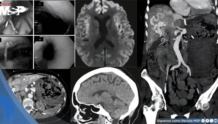 Hemorragia gastrointestinal provoc&oacute; edema cerebral en paciente con Telangiectasia y malformaci&oacute;n hep&aacute;tica