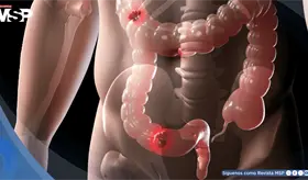 Consumo elevado de alcohol acumulado a lo largo de la vida aumenta 95% riesgo de c&aacute;ncer de recto