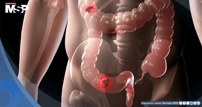 Consumo elevado de alcohol acumulado a lo largo de la vida aumenta 95% riesgo de cáncer de recto Consumo elevado de alcohol acumulado a lo largo de la vida aumenta 95% riesgo de cáncer de recto
