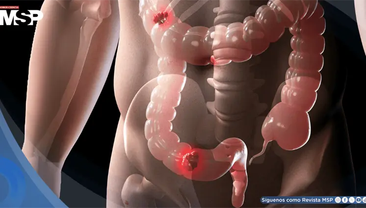 Consumo elevado de alcohol acumulado a lo largo de la vida aumenta 95% riesgo de cáncer de recto Consumo elevado de alcohol acumulado a lo largo de la vida aumenta 95% riesgo de cáncer de recto