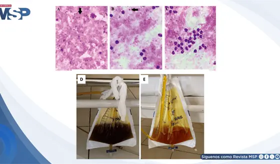Fiebre persistente y deterioro neurol&oacute;gico result&oacute; en malaria grave por Plasmodium falciparum