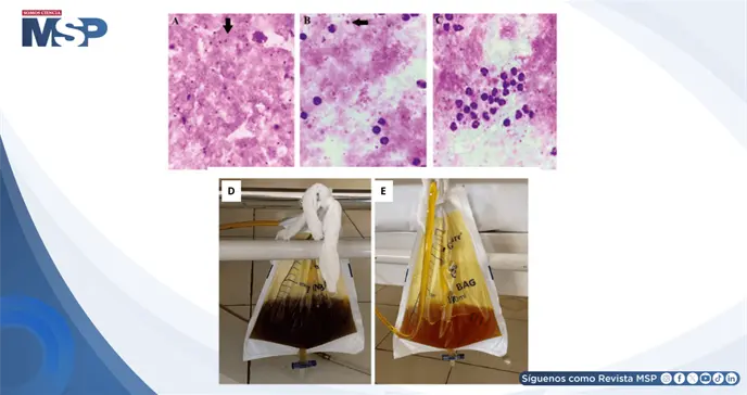 Fiebre persistente y deterioro neurol&oacute;gico result&oacute; en malaria grave por Plasmodium falciparum