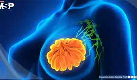 Inhibidor CDK 4/6 prolonga 15 meses supervivencia en pacientes con c&aacute;ncer de mama metast&aacute;sico HR+ y HER2+