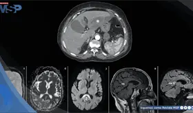 Neurotoxicidad por metronidazol tras tratamiento prolongado de absceso hepático en adulta mayor