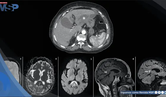 Neurotoxicidad por metronidazol tras tratamiento prolongado de absceso hep&aacute;tico en adulta mayor
