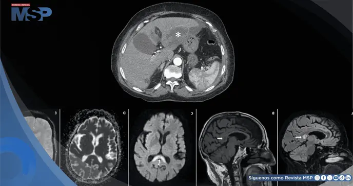 Neurotoxicidad por metronidazol tras tratamiento prolongado de absceso hepático en adulta mayor Neurotoxicidad por metronidazol tras tratamiento prolongado de absceso hepático en adulta mayor