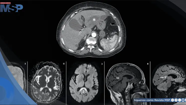 Neurotoxicidad por metronidazol tras tratamiento prolongado de absceso hep&aacute;tico en adulta mayor
