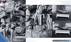 Hallazgos anatómicos tras histerectomía: Struma ovarii, fibrosis pélvica extensa y megacolon en donante