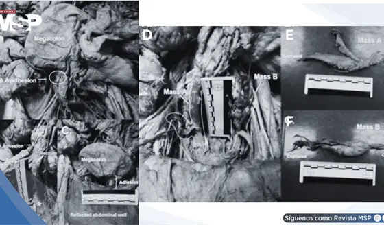 Hallazgos anat&oacute;micos tras histerectom&iacute;a: Struma ovarii, fibrosis p&eacute;lvica extensa y megacolon en donante 