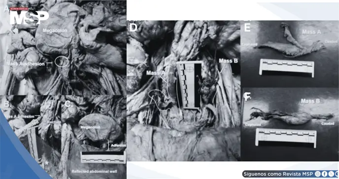 Hallazgos anatómicos tras histerectomía: Struma ovarii, fibrosis pélvica extensa y megacolon en donante Hallazgos anatómicos tras histerectomía: Struma ovarii, fibrosis pélvica extensa y megacolon en donante