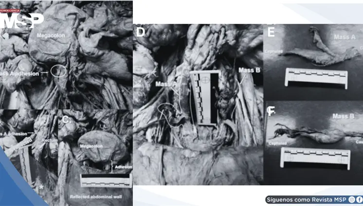 Hallazgos anatómicos tras histerectomía: Struma ovarii, fibrosis pélvica extensa y megacolon en donante Hallazgos anatómicos tras histerectomía: Struma ovarii, fibrosis pélvica extensa y megacolon en donante