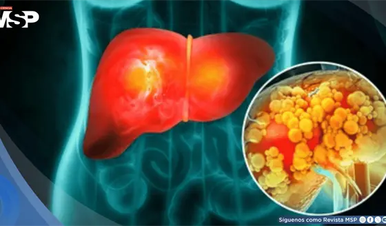 Estr&eacute;s cr&oacute;nico podr&iacute;a aumentar el riesgo de desarrollar h&iacute;gado graso y resistencia a la insulina
