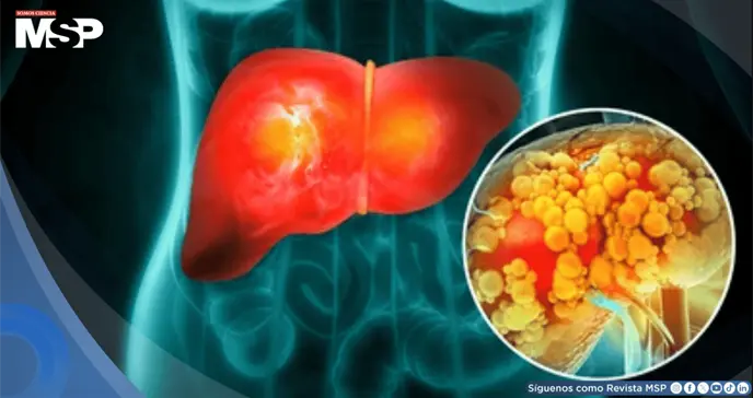 Estrés crónico podría aumentar el riesgo de desarrollar hígado graso y resistencia a la insulina Estrés crónico podría aumentar el riesgo de desarrollar hígado graso y resistencia a la insulina