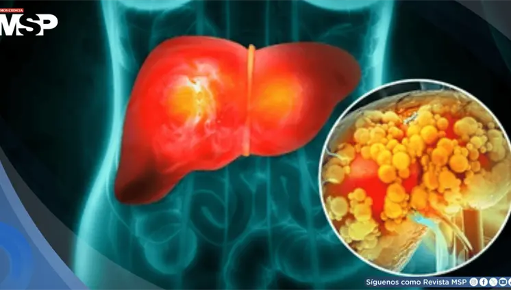 Estrés crónico podría aumentar el riesgo de desarrollar hígado graso y resistencia a la insulina Estrés crónico podría aumentar el riesgo de desarrollar hígado graso y resistencia a la insulina