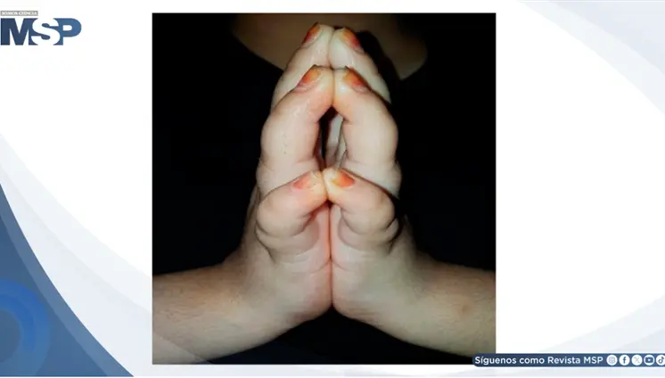 Rigidez y limitaci&oacute;n de movilidad revelan queiroartropat&iacute;a diab&eacute;tica en adolescente con diabetes tipo 1