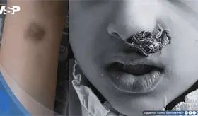 Anemia ferrop&eacute;nica recurrente y sangrado mucocut&aacute;neo desde la ni&ntilde;ez  resultan en trombastenia de Glanzman