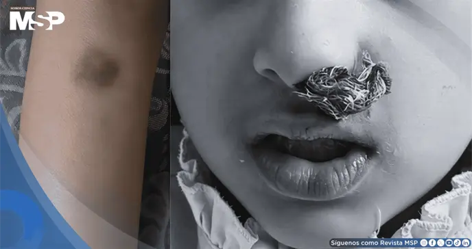 Anemia ferrop&eacute;nica recurrente y sangrado mucocut&aacute;neo desde la ni&ntilde;ez  resultan en trombastenia de Glanzman