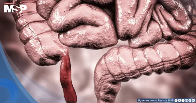 Dolor abdominal, n&aacute;useas y fiebre: &iquest;C&oacute;mo reconocer y tratar la apendicitis?