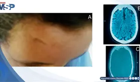 Traumatismo craneal en la infancia e hiperostosis frontal se manifiesta con psicosis severa en la adultez