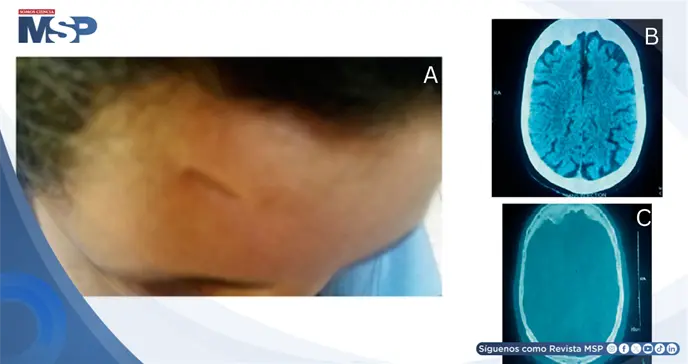 Traumatismo craneal en la infancia e hiperostosis frontal se manifiesta con psicosis severa en la adultez