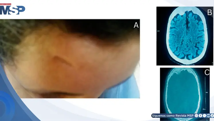Traumatismo craneal en la infancia e hiperostosis frontal se manifiesta con psicosis severa en la adultez Traumatismo craneal en la infancia e hiperostosis frontal se manifiesta con psicosis severa en la adultez