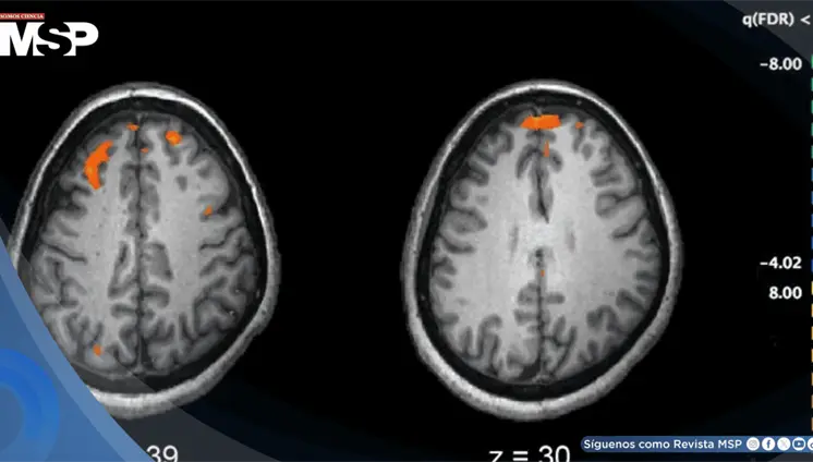 Desapego social y restricción afectiva en mujer resulta en trastorno de personalidad esquizoide Desapego social y restricción afectiva en mujer resulta en trastorno de personalidad esquizoide