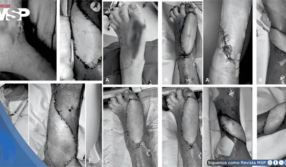 Hemorragias cut&aacute;neas complican rehabilitaci&oacute;n de 3 pacientes diab&eacute;ticos con colgajo en el pie