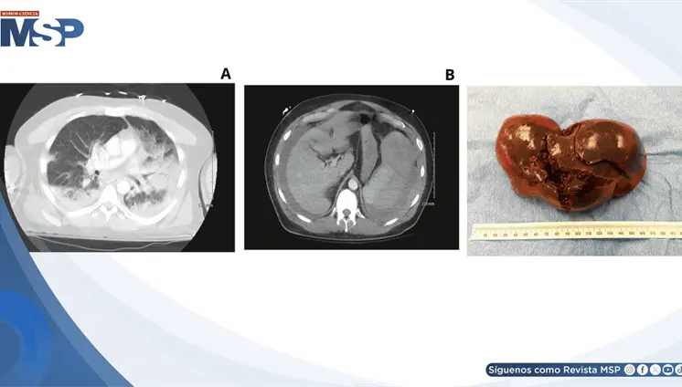 Ruptura esplénica atraumática asociada a Influenza A (H1N1) con pancreatitis en paciente de 50 años Ruptura esplénica atraumática asociada a Influenza A (H1N1) con pancreatitis en paciente de 50 años