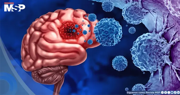 Parche postquir&uacute;rgico reducir&iacute;a la recurrencia del glioblastoma: ataca el 90% de c&eacute;lulas tumorales 