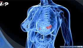 As&iacute; es como la nutrici&oacute;n podr&iacute;a reducir el riesgo de met&aacute;stasis en el c&aacute;ncer de mama