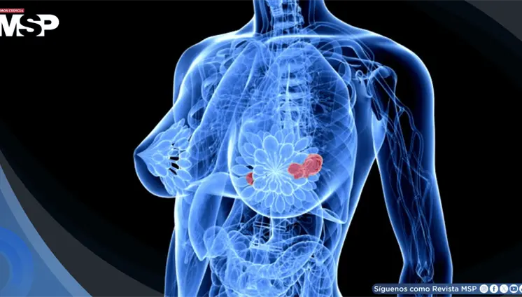 Así es como la nutrición podría reducir el riesgo de metástasis en el cáncer de mama Así es como la nutrición podría reducir el riesgo de metástasis en el cáncer de mama