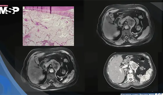 C&aacute;ncer renal reaparece como met&aacute;stasis pancre&aacute;tica siete a&ntilde;os despu&eacute;s en mujer de 60 a&ntilde;os con hematuria 