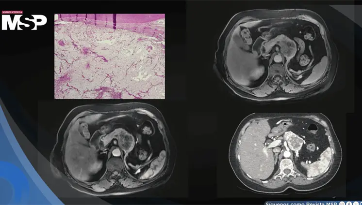 Cáncer renal reaparece como metástasis pancreática siete años después en mujer de 60 años con hematuria Cáncer renal reaparece como metástasis pancreática siete años después en mujer de 60 años con hematuria