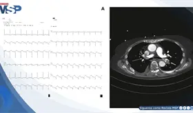 Embolia pulmonar masiva simul&oacute; infarto agudo de miocardio en paciente con troponina elevada