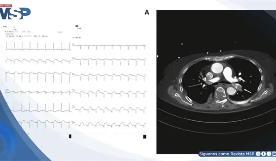 Embolia pulmonar masiva simul&oacute; infarto agudo de miocardio en paciente con troponina elevada