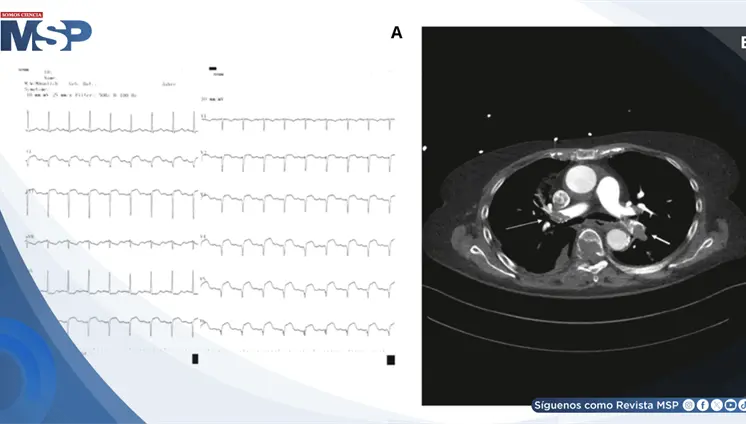 Embolia pulmonar masiva simul&oacute; infarto agudo de miocardio en paciente con troponina elevada
