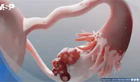 &iquest;Por qu&eacute; el c&aacute;ncer de ovario se propaga r&aacute;pido?C&eacute;lulas protectoras se convierten en c&oacute;mplices del tumor