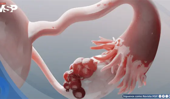 &iquest;Por qu&eacute; el c&aacute;ncer de ovario se propaga r&aacute;pido?C&eacute;lulas protectoras se convierten en c&oacute;mplices del tumor