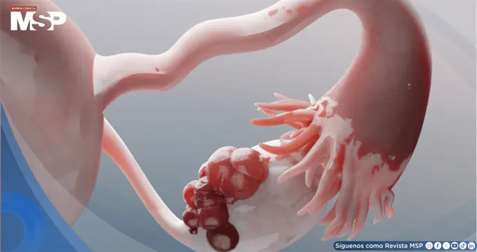 ¿Por qué el cáncer de ovario se propaga rápido?Células protectoras se convierten en cómplices del tumor