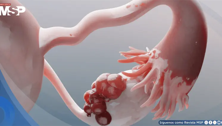 &iquest;Por qu&eacute; el c&aacute;ncer de ovario se propaga r&aacute;pido?C&eacute;lulas protectoras se convierten en c&oacute;mplices del tumor