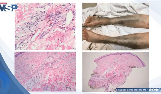 Hiperpigmentaci&oacute;n cut&aacute;nea aguda por acumulaci&oacute;n de levofloxacino en paciente con enfermedad renal cr&oacute;nica