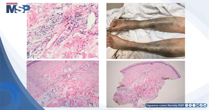 Hiperpigmentaci&oacute;n cut&aacute;nea aguda por acumulaci&oacute;n de levofloxacino en paciente con enfermedad renal cr&oacute;nica