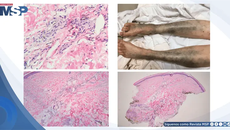 Hiperpigmentación cutánea aguda por acumulación de levofloxacino en paciente con enfermedad renal crónica Hiperpigmentación cutánea aguda por acumulación de levofloxacino en paciente con enfermedad renal crónica