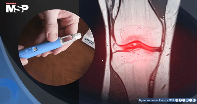Semaglutida podr&iacute;a frenar la artrosis al proteger el cart&iacute;lago, m&aacute;s all&aacute; de la p&eacute;rdida de peso: Estudio