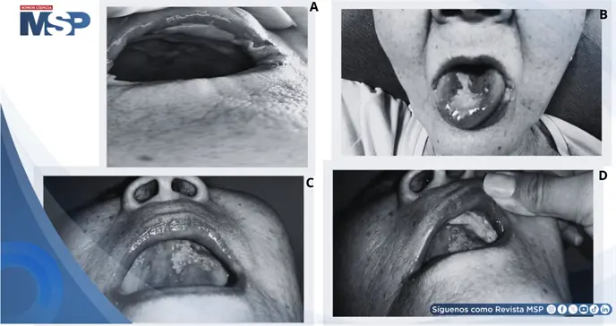 Mala administraci&oacute;n de alendronato provoca graves lesiones orales en paciente con osteoporosis