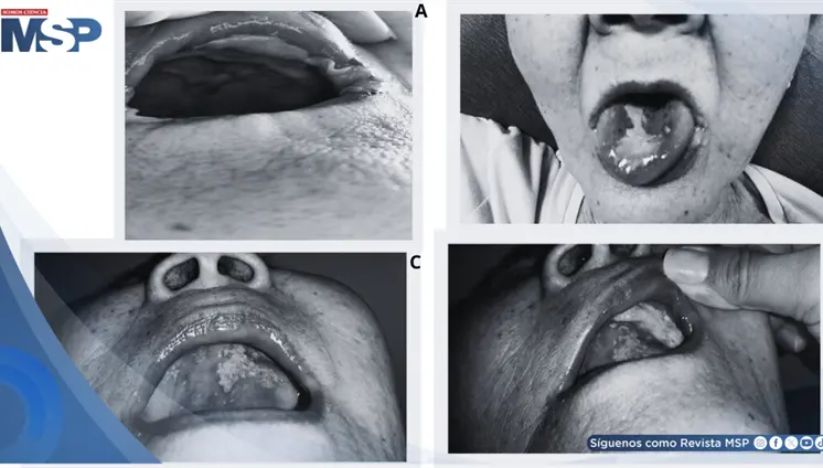 Mala administración de alendronato provoca graves lesiones orales en paciente con osteoporosis Mala administración de alendronato provoca graves lesiones orales en paciente con osteoporosis